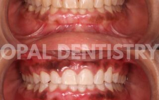 teeth whitening