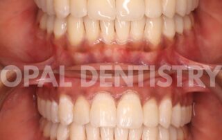teeth whitening