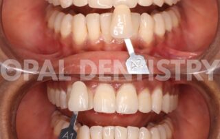 teeth whitening