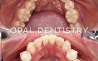 Dental Filling