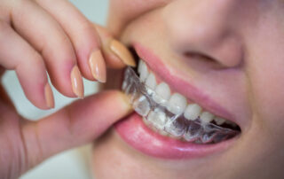 Invisalign