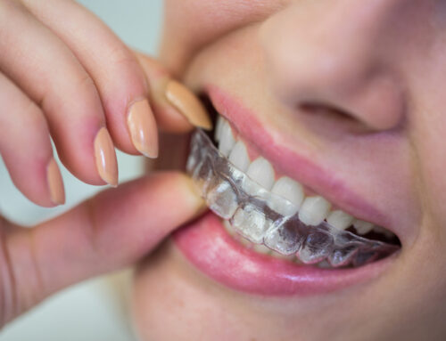 Cost Of Invisalign in Chennai: What You Need to Know