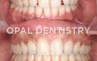 Lighten your gums