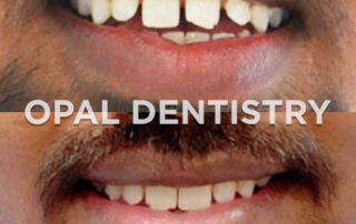 Visual comparison of filling vs crowning for damaged teeth