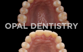 Fastest Ways to Fix Crooked Teeth 