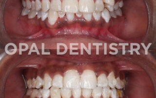Invisalign