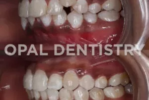 Bruxism