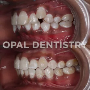 Bruxism