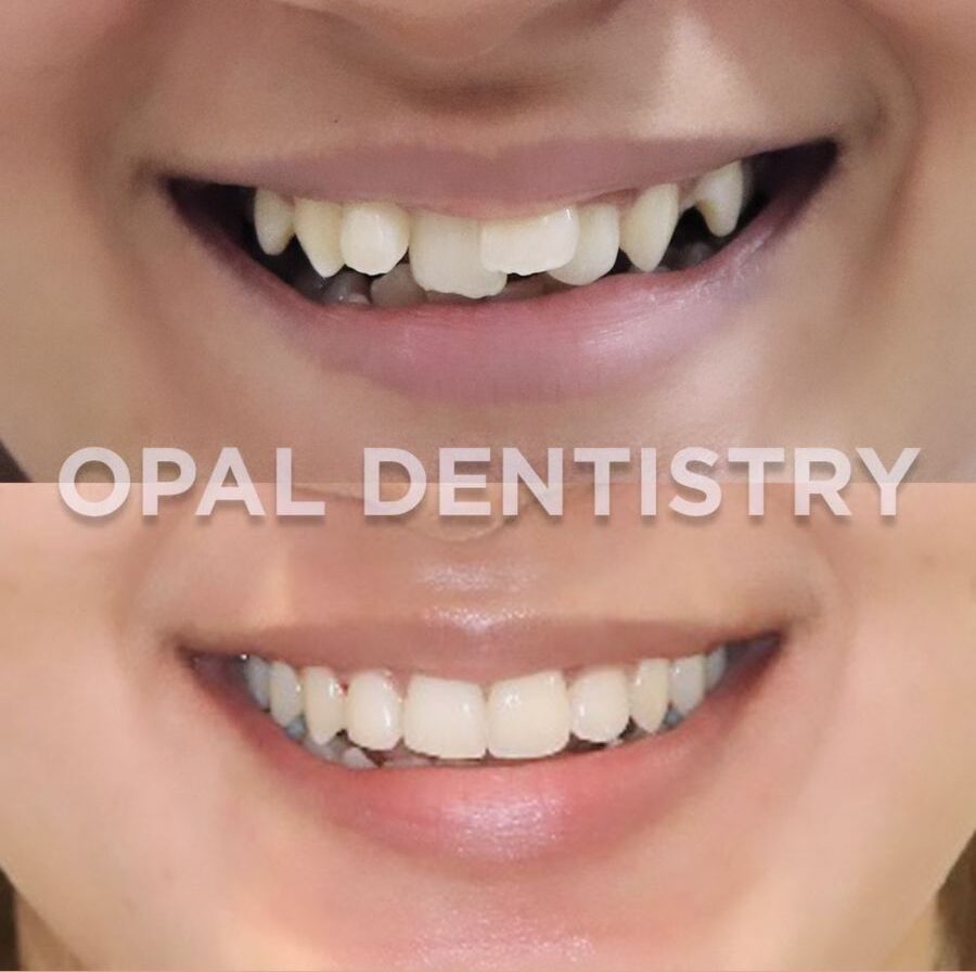 Smile correction with Invisalign
