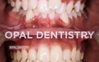 Fix crooked teeth