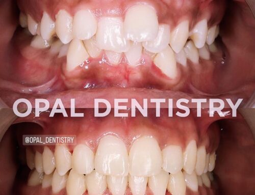 Why Is Invisalign the Best for Correcting Crooked Teeth?