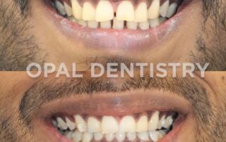teeth whitening