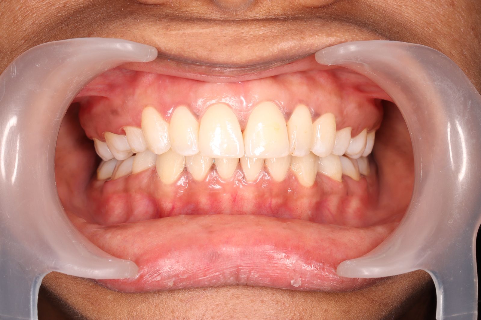 Fix tooth gap