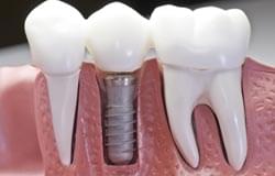 DENTAL-IMPLANTS
