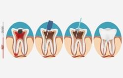 ROOT-CANAL-TREATMENT