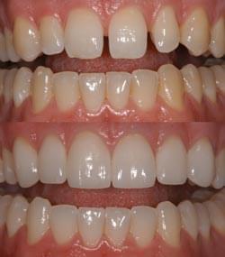 TEETH-BONDING