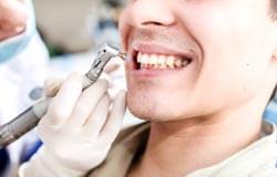 TEETH-WHITENING