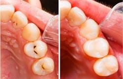 TOOTH-COLOURED-FILLINGS