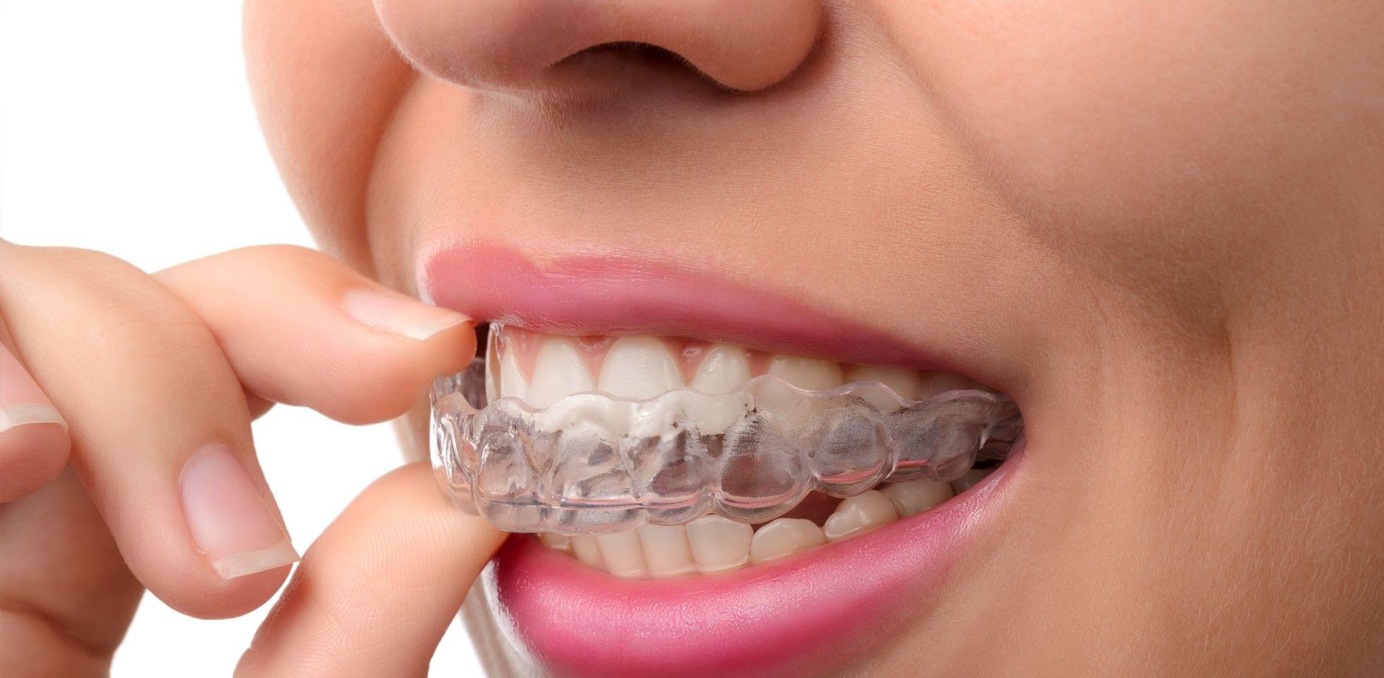invisalign