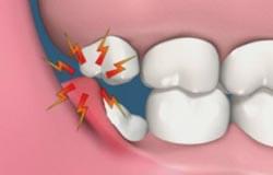 Wisdom-Teeth-removal