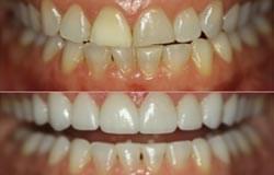 veneers