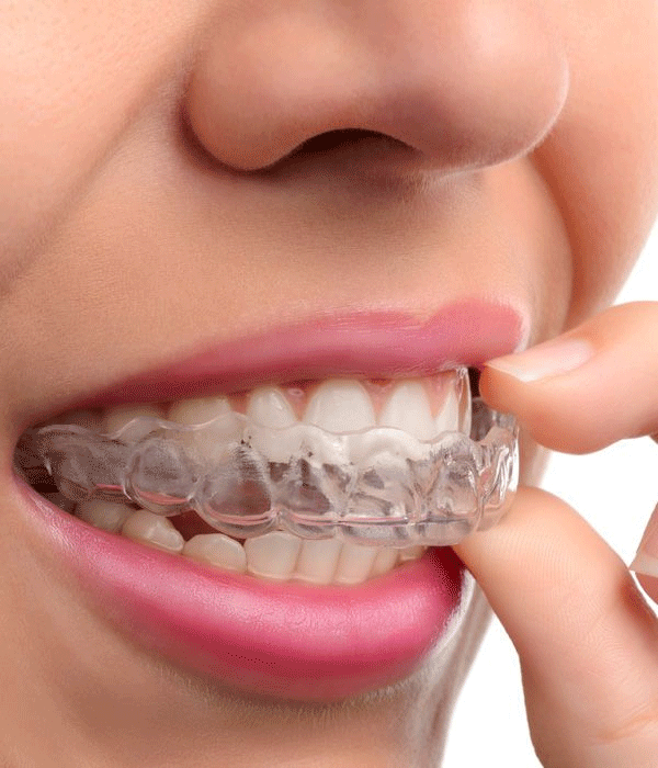 How long does Invisalign take to make your teeth beautiful? – TruCare  Dentistry