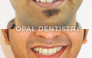 how to turn yellow teeth white