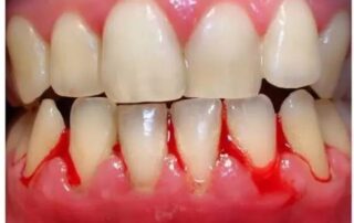 Gum Problem