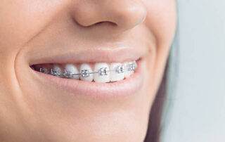 dental braces