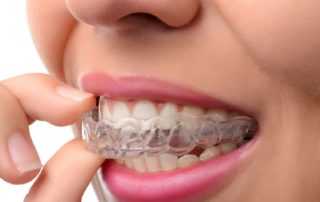 invisalign