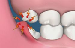 teeth-removal